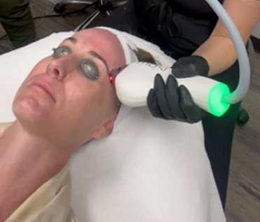 Sciton Moxi - Laser Procedures